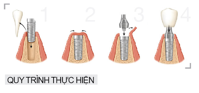 Trồng răng implant tại quận 10